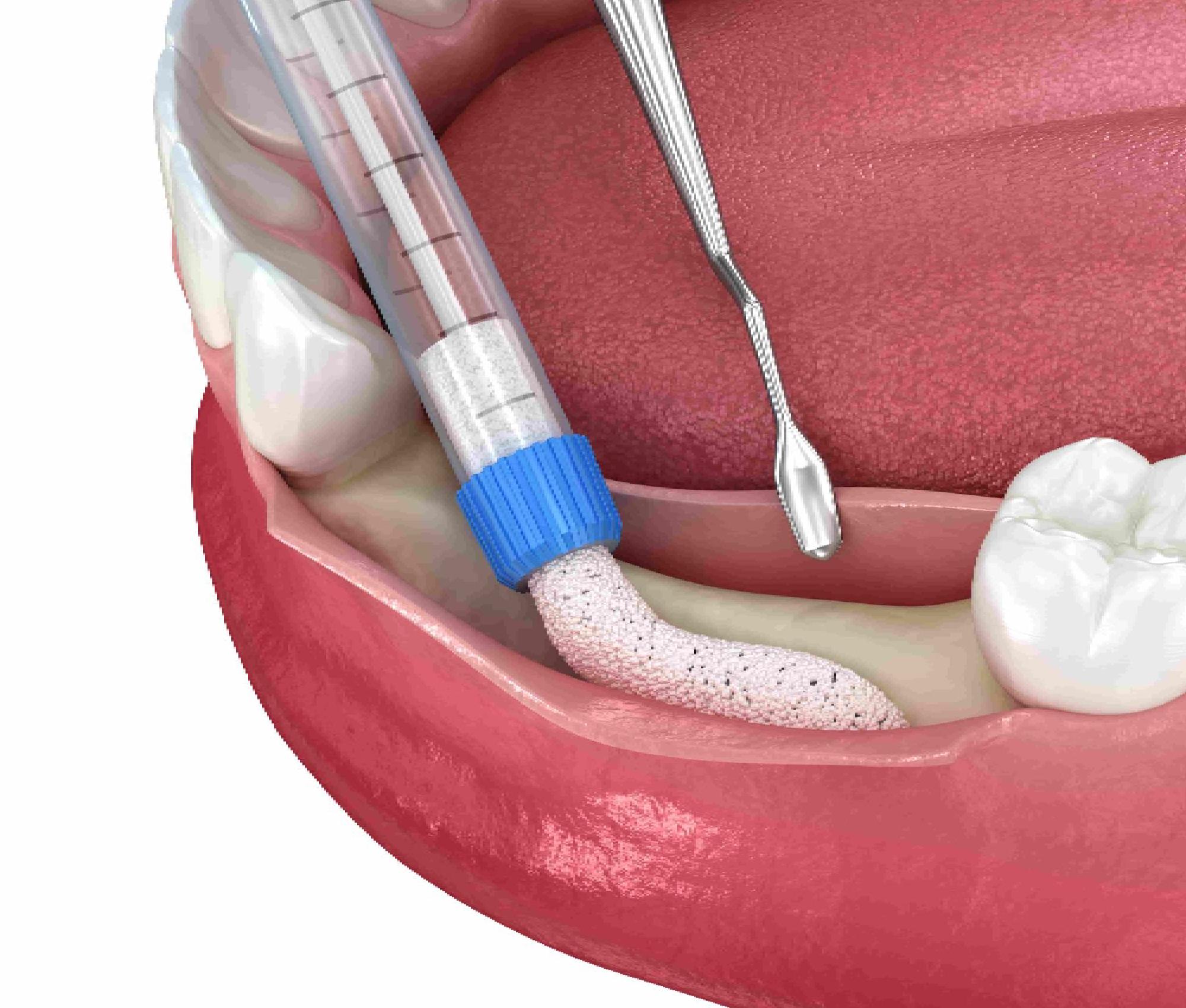 Dental bone grafting procedure with tools in mouth.