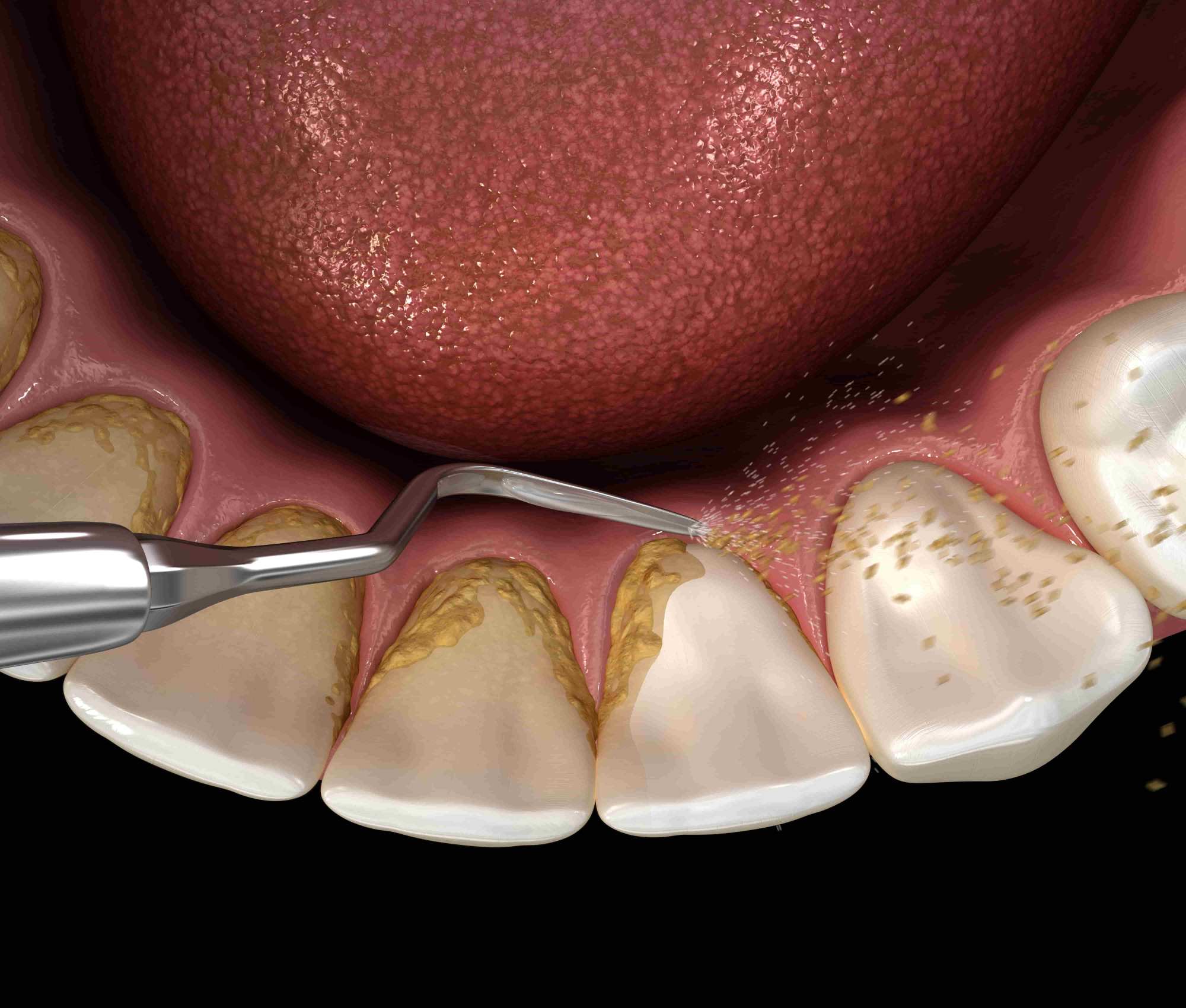 Dental calculus removal from teeth illustration.
