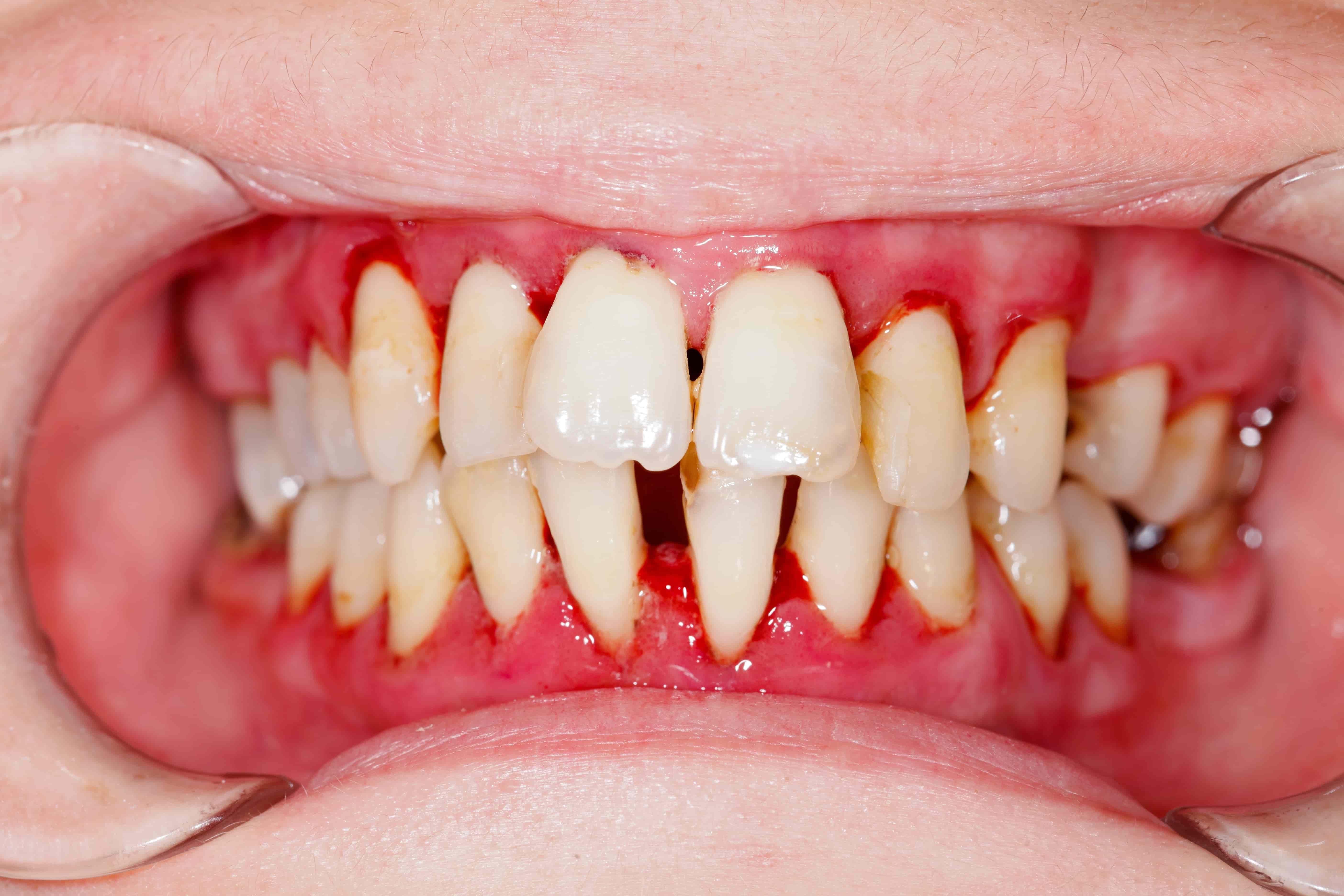 Close-up of inflamed gums and teeth