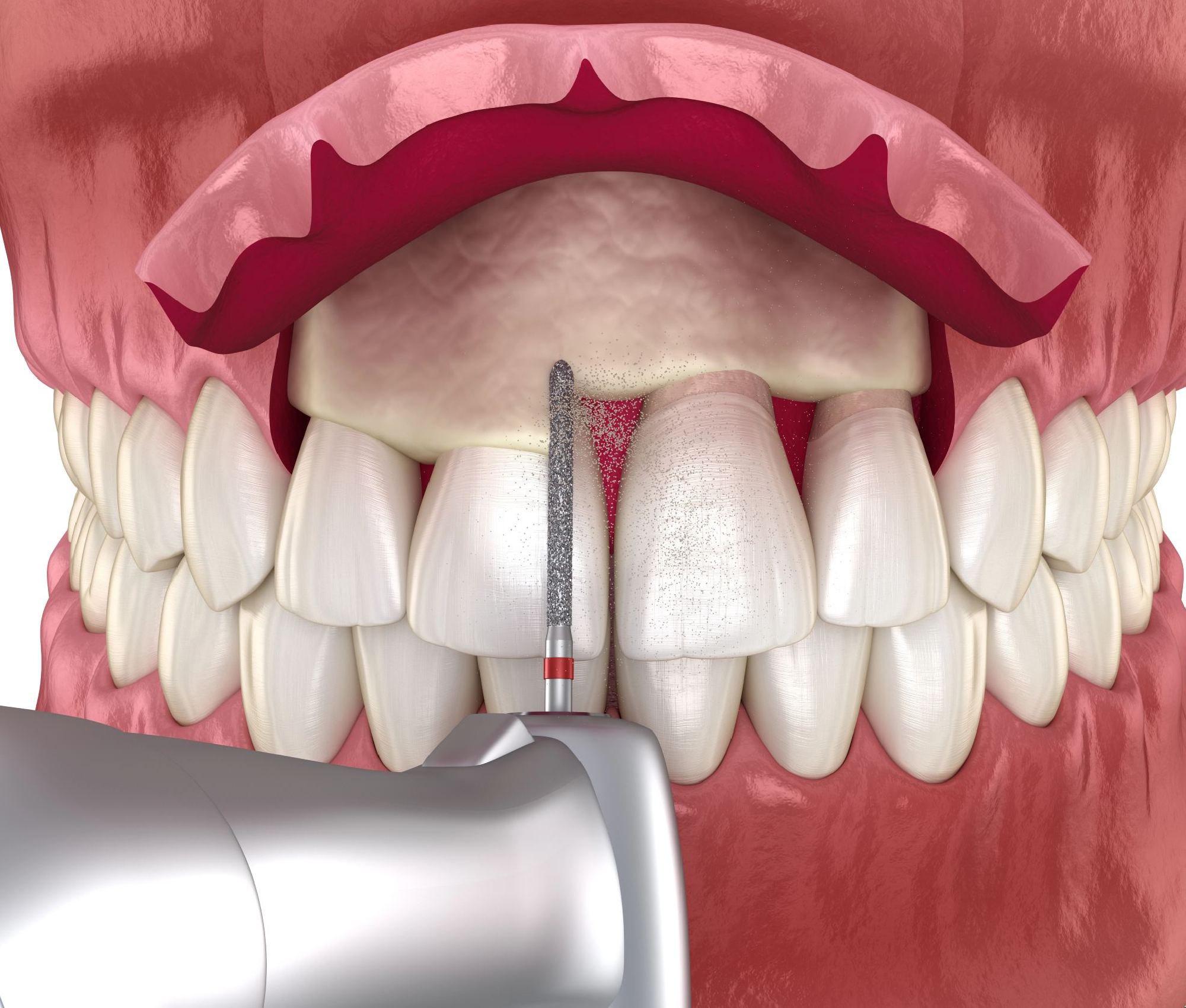 Gum surgery with dental tool on teeth.