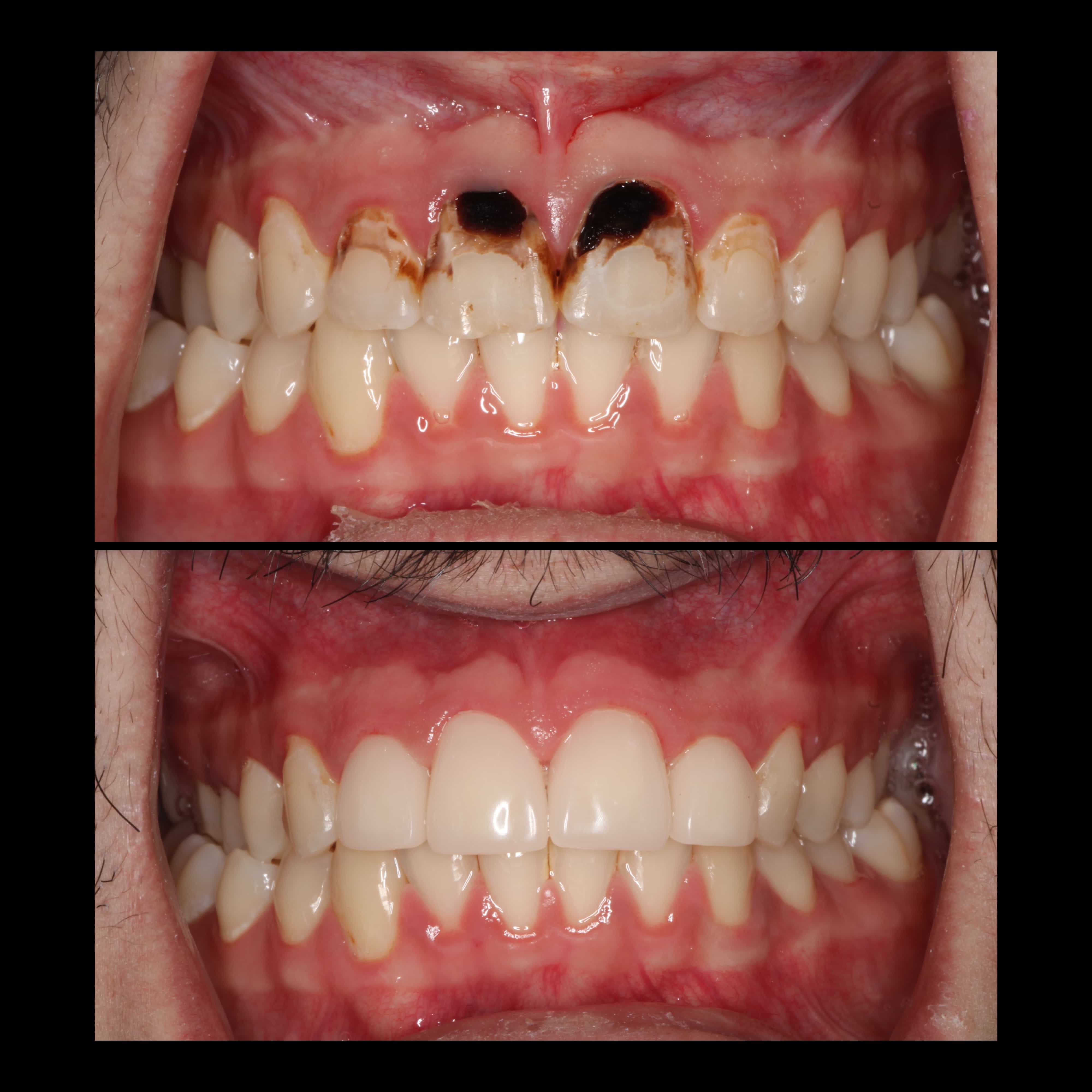 A smile with severe decay and black tarry stains is restored to a healthy looking smile.