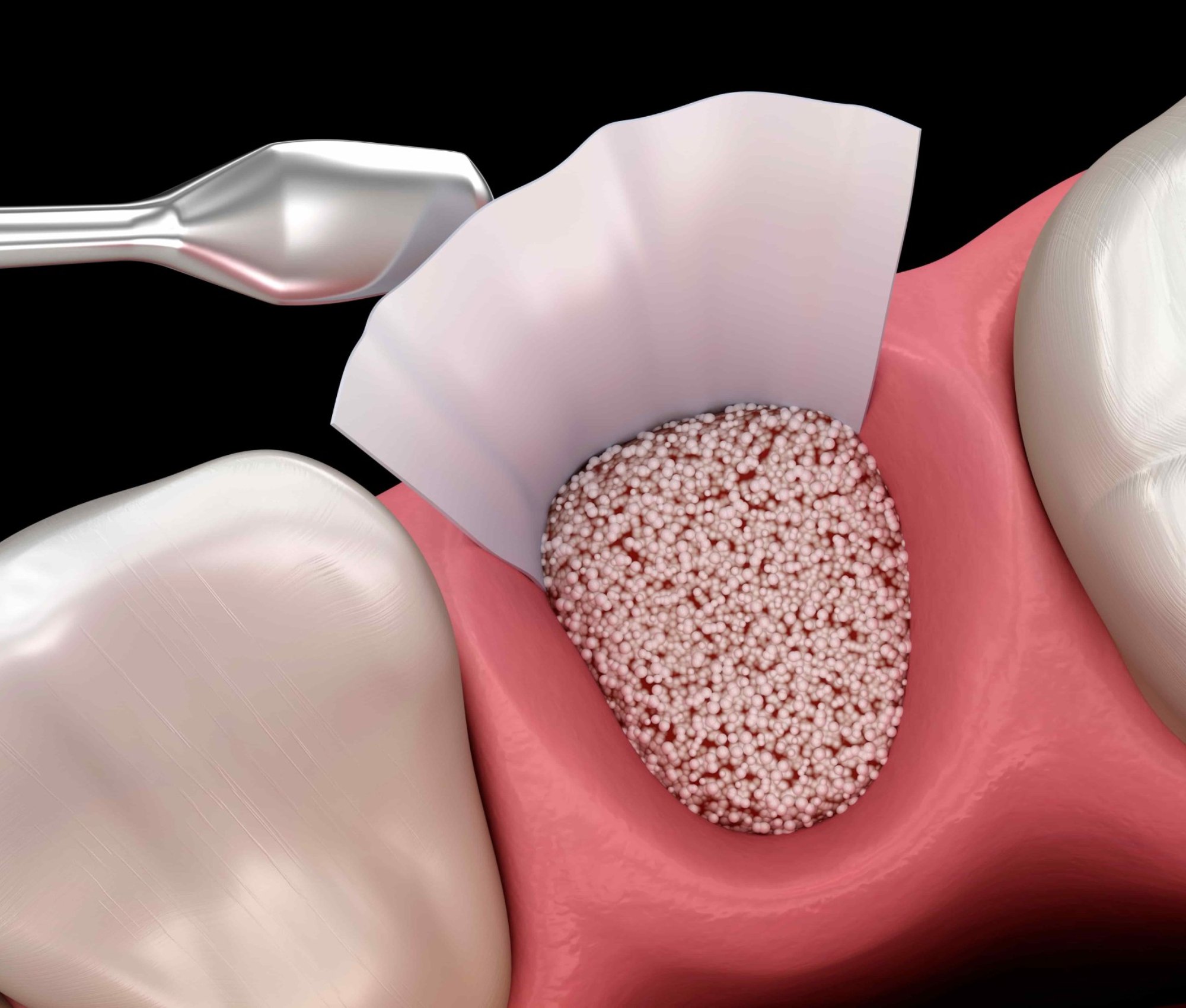 Dental bone graft procedure illustration