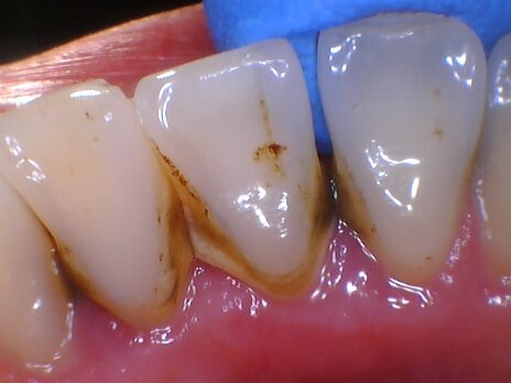 Close-up of stained teeth needing dental cleaning.